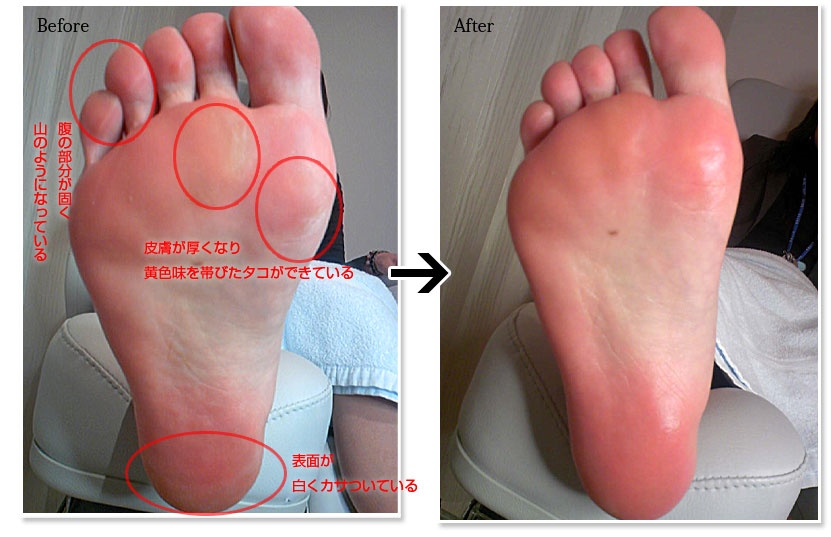 角質除去の施術前と施術後の比較