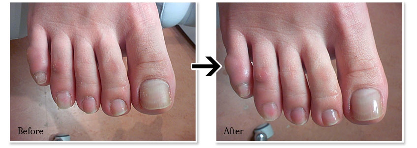 爪のケア施術前と施術後の比較