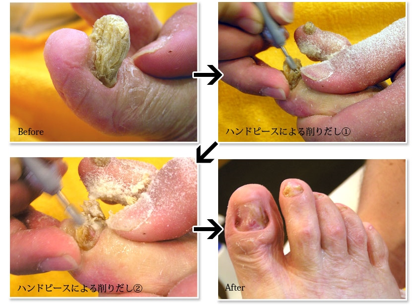 肥厚した爪の切削施術前と施術後の比較