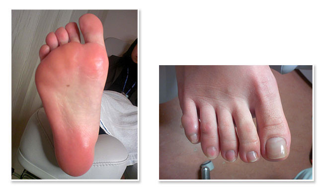 施術完了後の足の状態